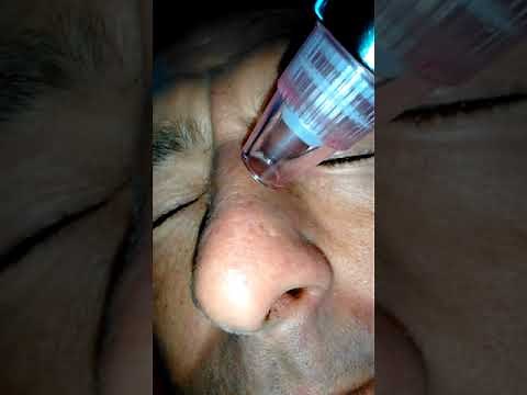 Satu Brown Blackhead Remover Vacuum