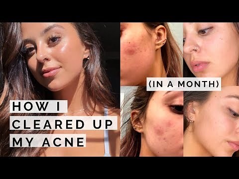how i cleared up my skin (in a month!)