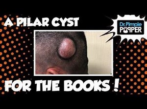 A Pilar Cyst for the Books