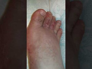 Bunion/hammer toe surgery post op recovery