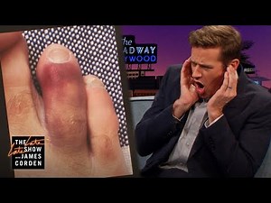 Armie Hammer Broke the Same Toe Twice