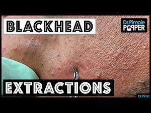 A Blackhead Extractor & Tweezer Dance
