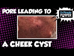 A Pore Leading into a Cheek Cyst