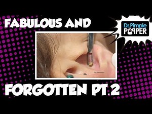 Blackheads: The Fabulous & Forgotten, Part Two (Ft. Pimple Pete!)