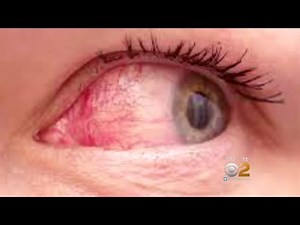 Dr. Max Gomez: Dry Eye Drug